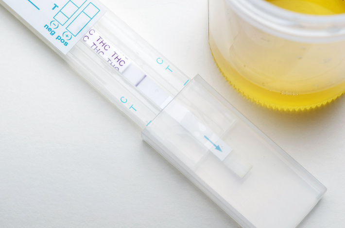 Marijuana drug test urine sample showing positive THC